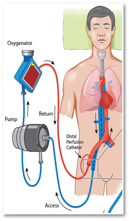 A diagram showing how ECMO works.